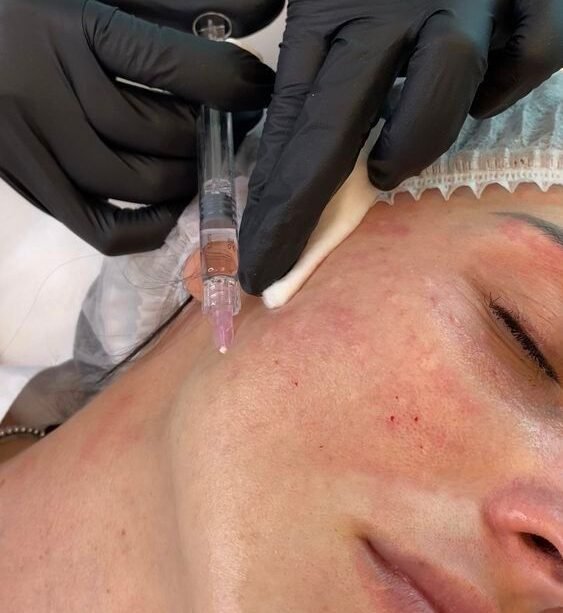 Polyneuclotides-face - Dr Hans Clinics