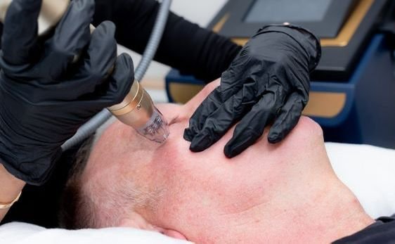 RF-Microneedling - Dr Hans Clinics Dr Hans Clinics London | Services | Dr Hansel treating a patient