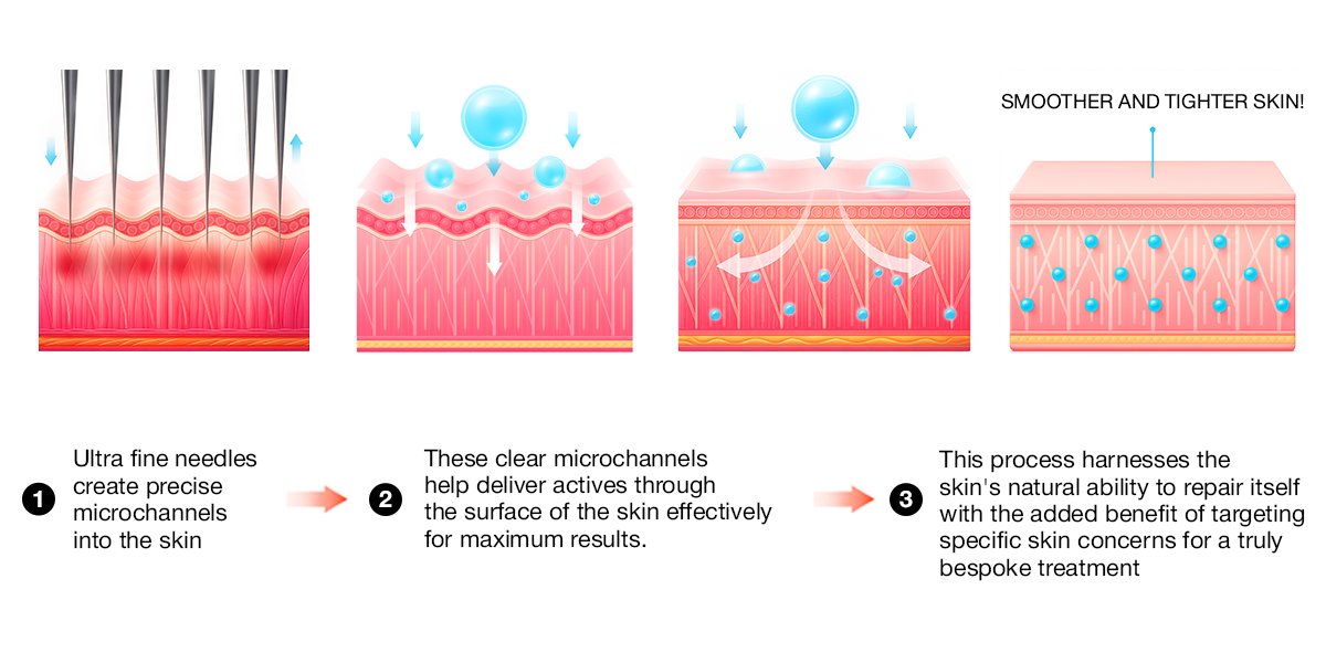 STEP RF Microneedling - Dr Hans Clinics