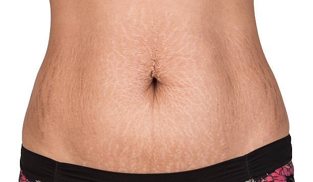 Women body with fat belly and stretch marks - Dr Hans Clinics