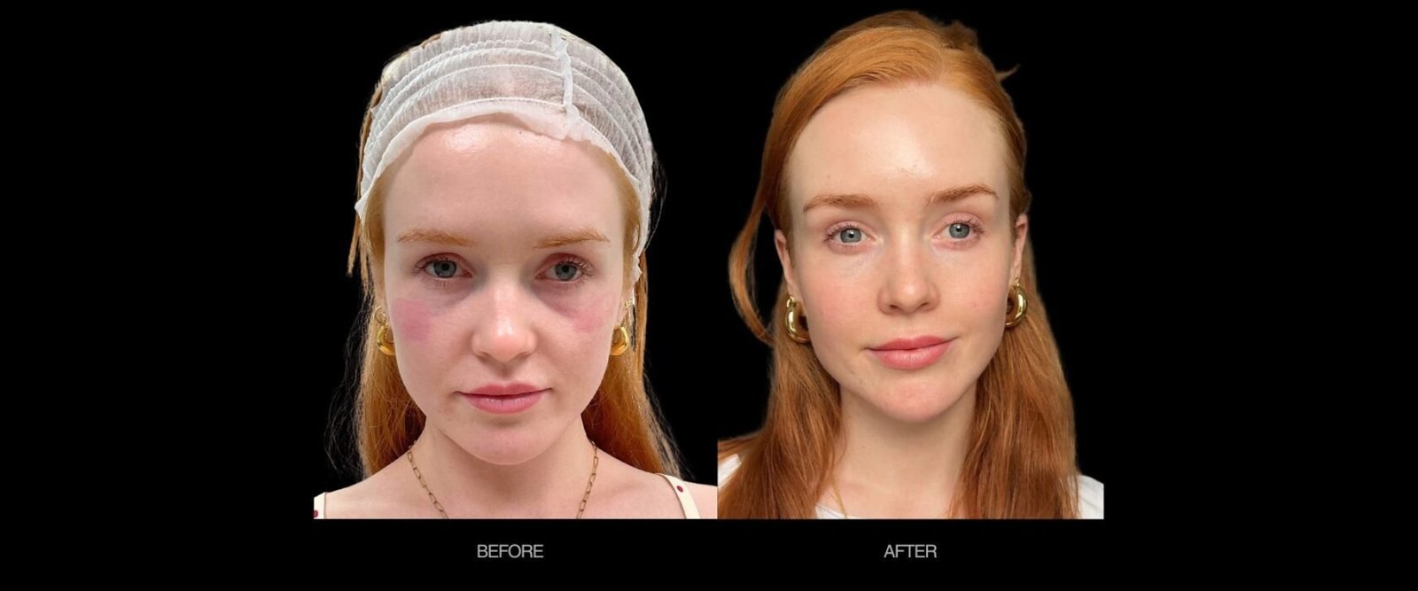 PRF Bio-Filler