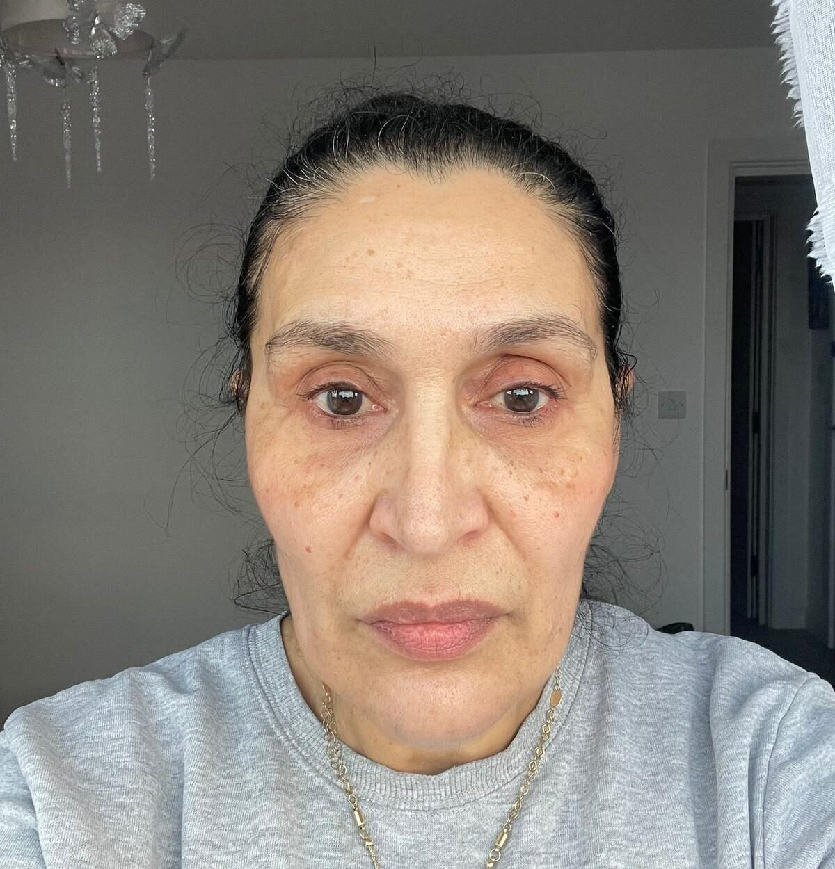 PRF EZ Gel London - Biofiller & Plasmagel - After - Dr. Hans Clinics