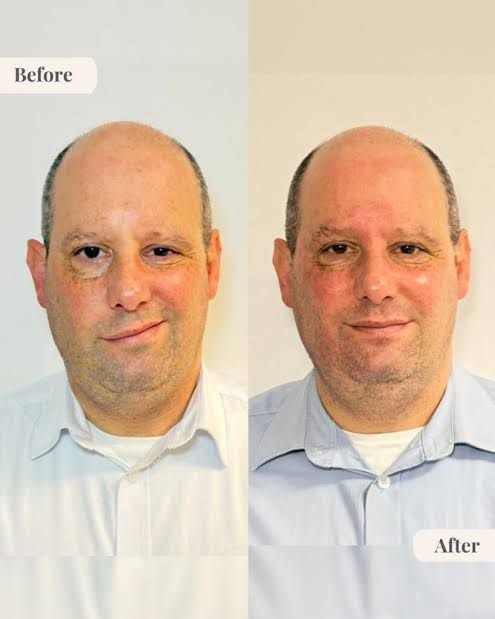 3 - Dr Hans Clinics - Dr Hans Clinics Side-by-side portrait of a man before and after hair restoration, with 'Before' and 'After' labels visible on each side.