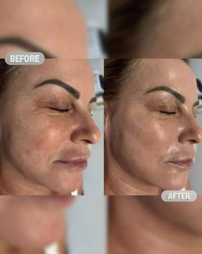 4 - Dr Hans Clinics - Dr Hans Clinics Split-image collage: a woman's side profile before (left) and after (right) a skincare treatment, showing smoother, glowy skin in the after panel.