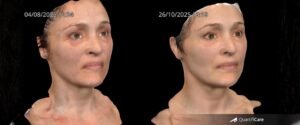 Side-by-side before-and-after portraits of a woman, showing facial skin improvement after cosmetic treatment; dates 04/08/2025 12:34 and 26/10/2025 13:19 appear at the top, with a QuantifiCare logo bottom-right.