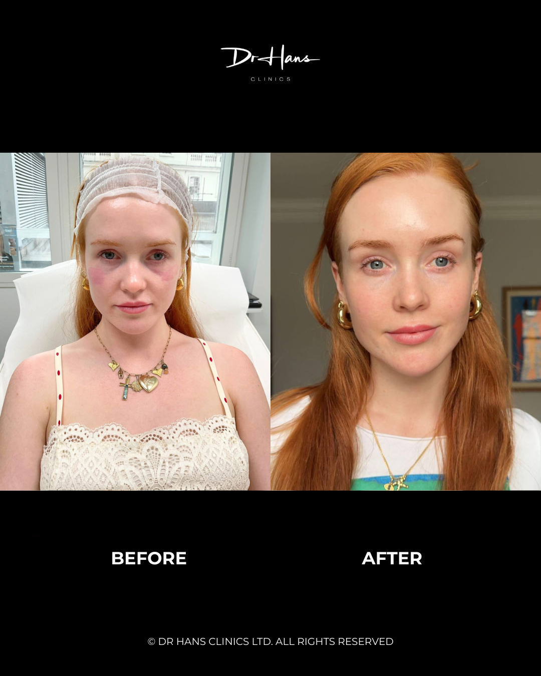 Split-screen showing a woman before and after facial treatment at Dr Hans Clinics: left image with bruising under the eyes and a headband, right image with smoother, more even skin tone and a refreshed appearance.