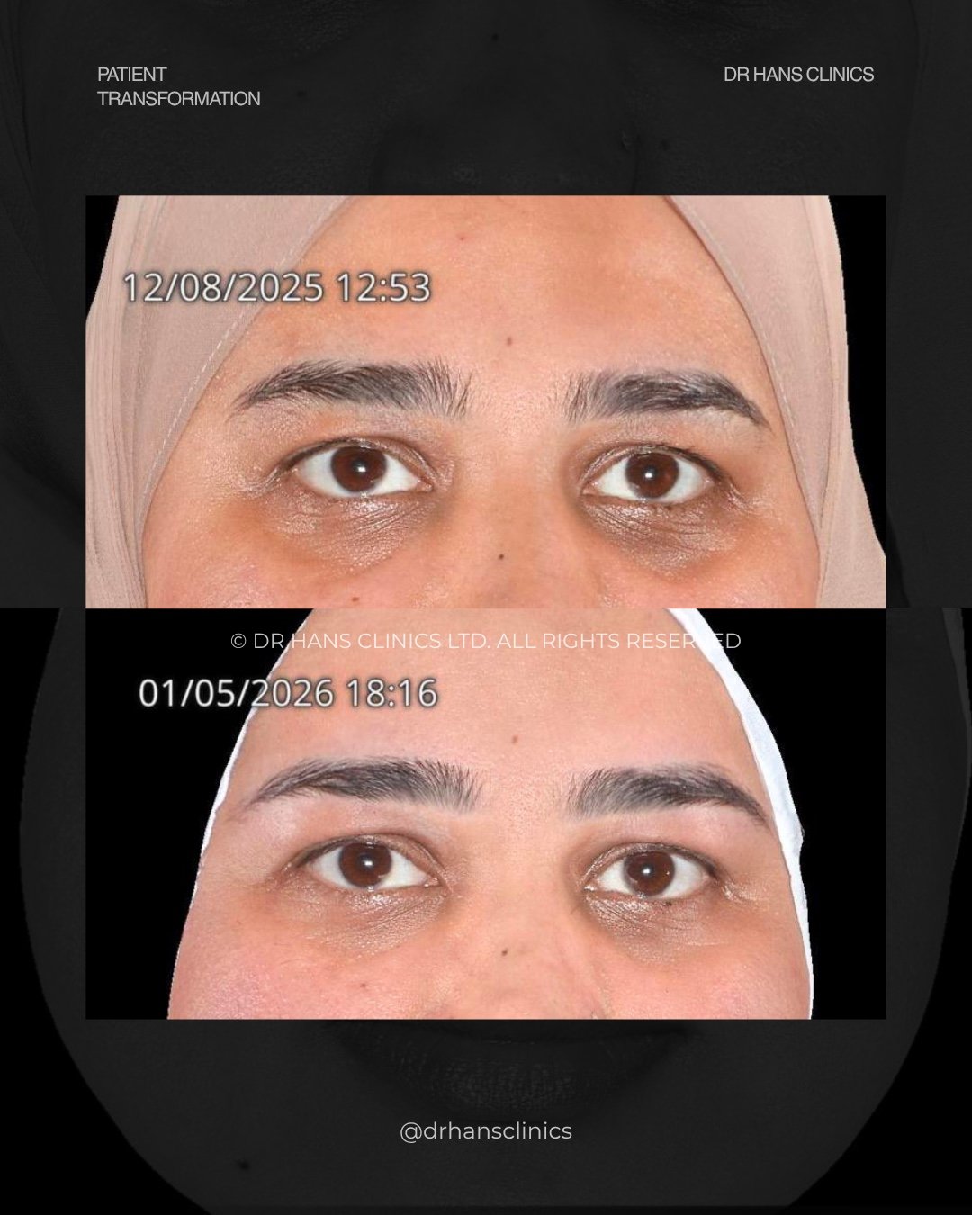 Two-panel close-up of a woman's eyes showing a before (top) and after (bottom) eyelid/eyebrow transformation from a clinic treatment, with timestamps visible on each image.