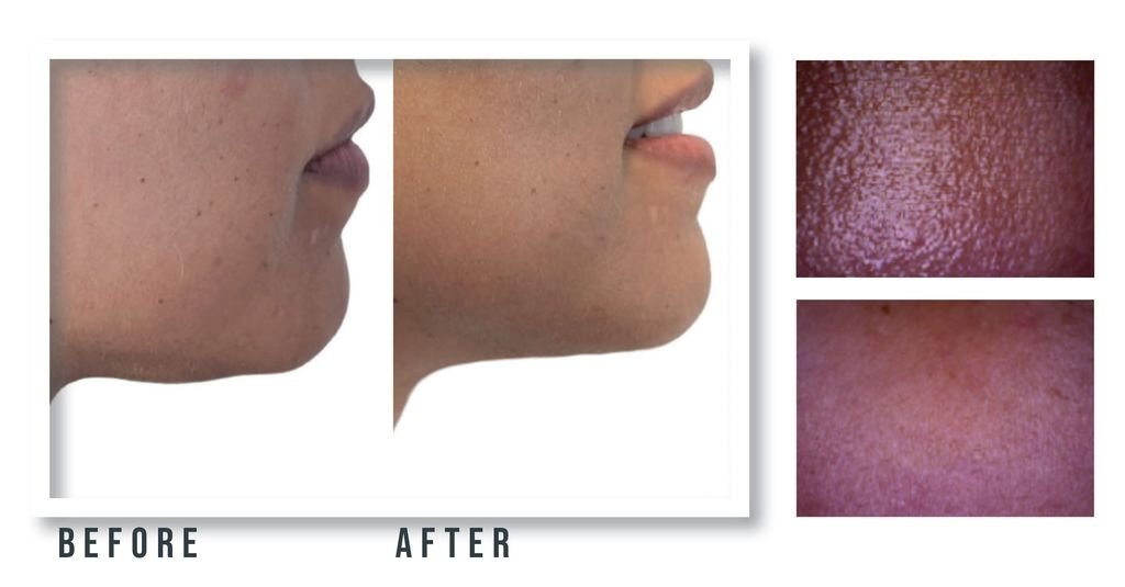 Side-by-side before and after photos of the chin and jawline showing smoother, clearer skin after treatment on the right vs left.