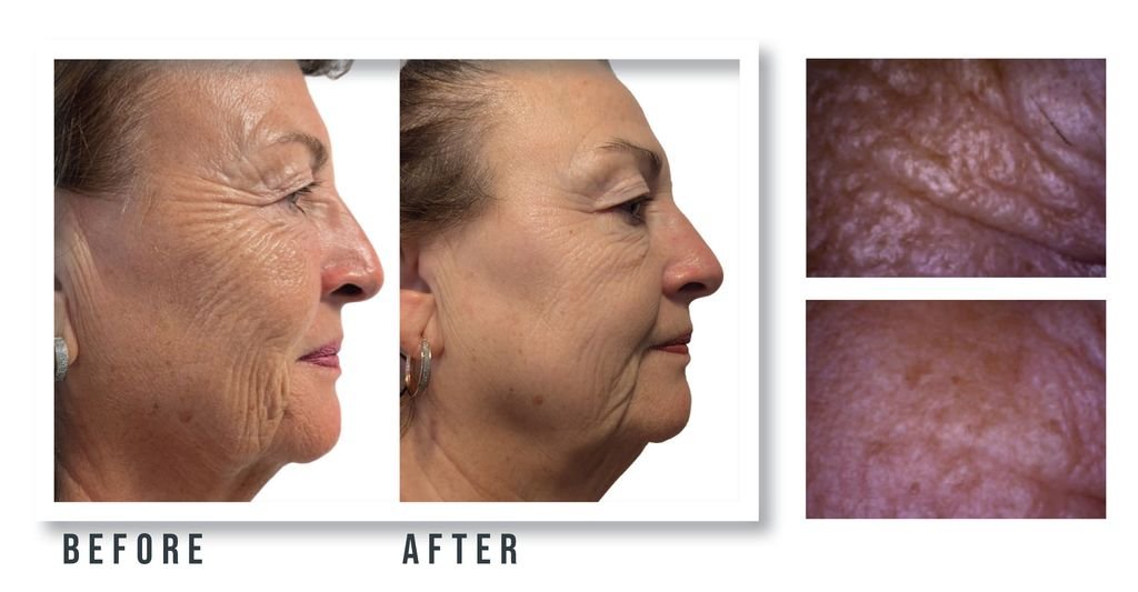 Before and after photos of a woman's profile showing wrinkle reduction after treatment; right side has two close-up skin textures.