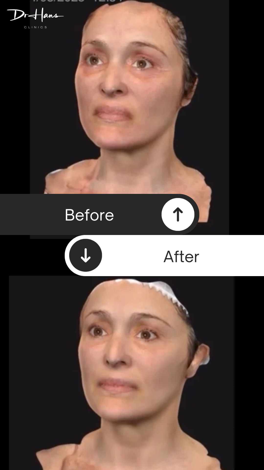 Tixel - Before and After - Dr Hans Clinics London