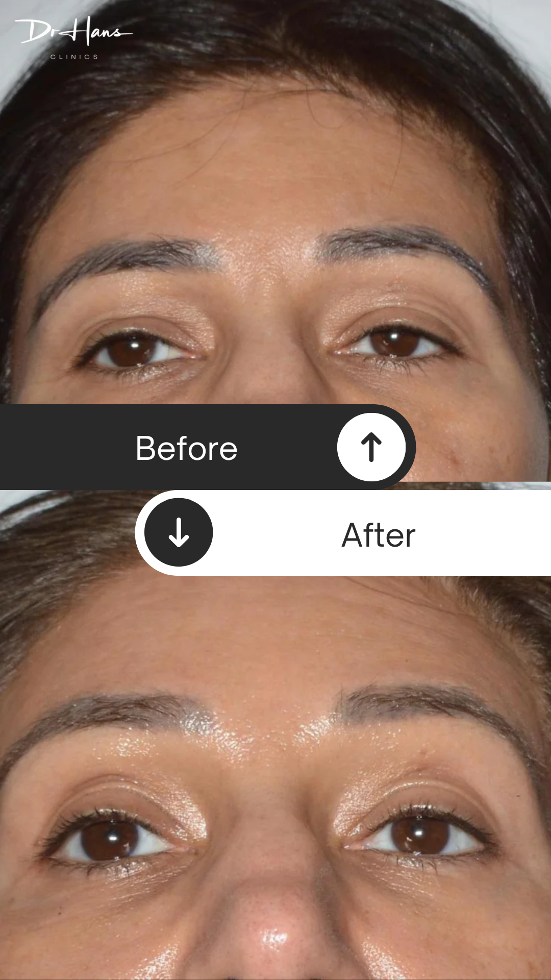 Tixel - Before and After - Dr Hans Clinics London