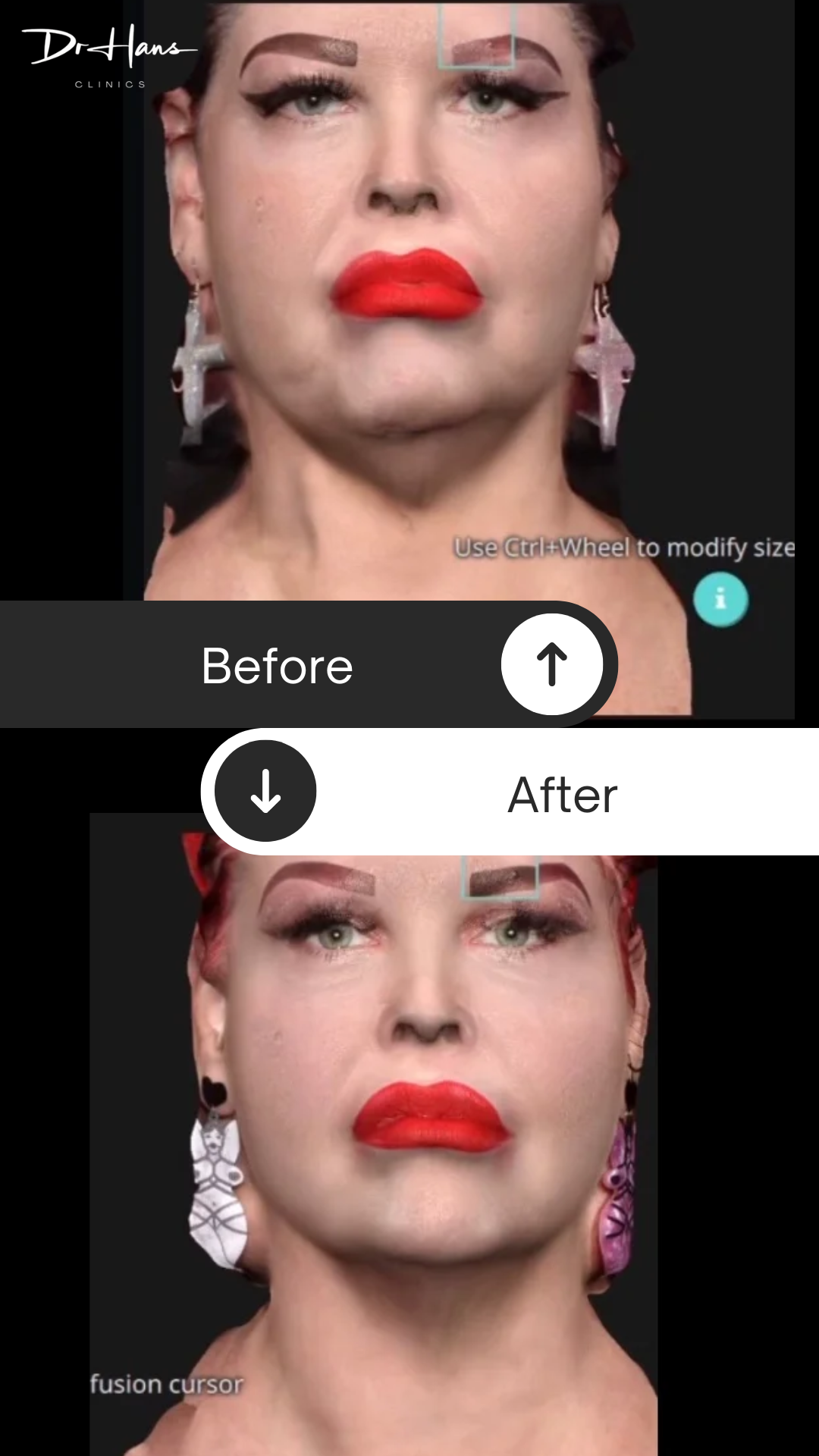 Tixel - Before and After - Dr Hans Clinics London