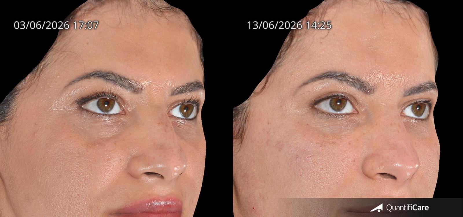 Side-by-side close-up of a woman's face showing before (left, 03/06/2026) and after (right, 13/06/2026) skin improvement under a black background for a cosmetic treatment comparison.