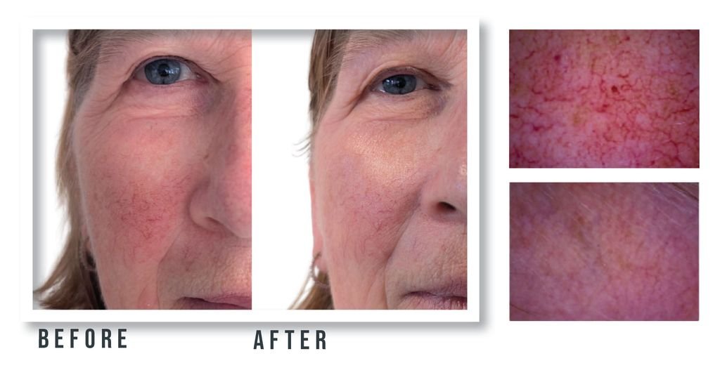 Side-by-side before-and-after close-ups of a woman's cheek showing reduced redness after treatment, with 'Before' and 'After' captions.