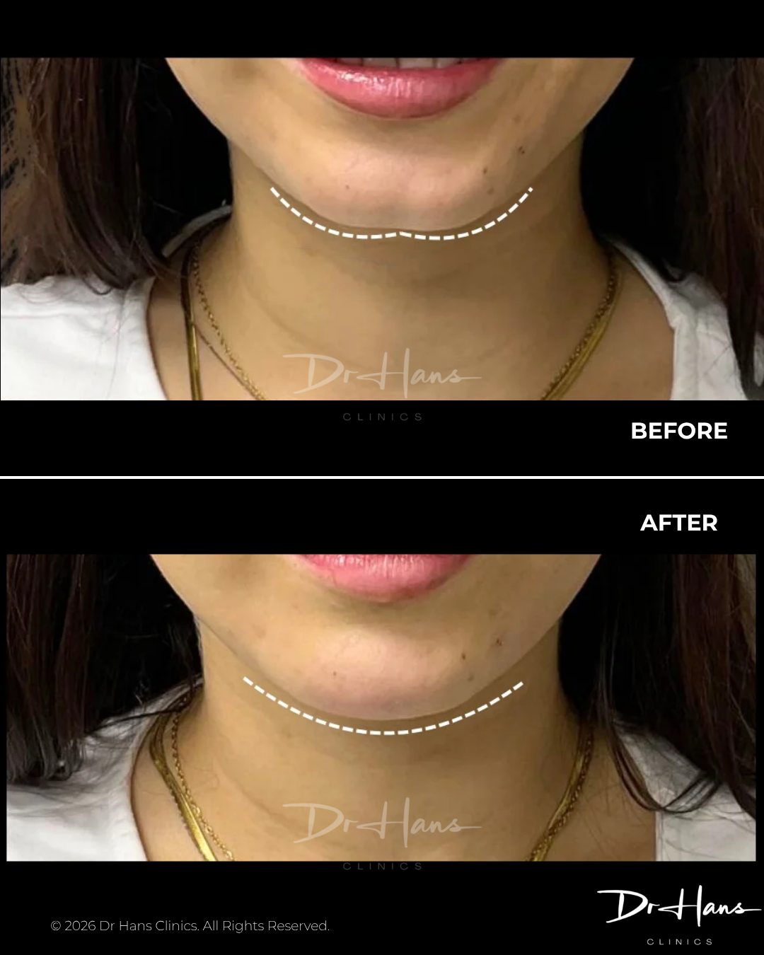 Before-and-after photo pair showing improved chin/neck contour; dotted curved line marks the intended jawline contour on the neck area.