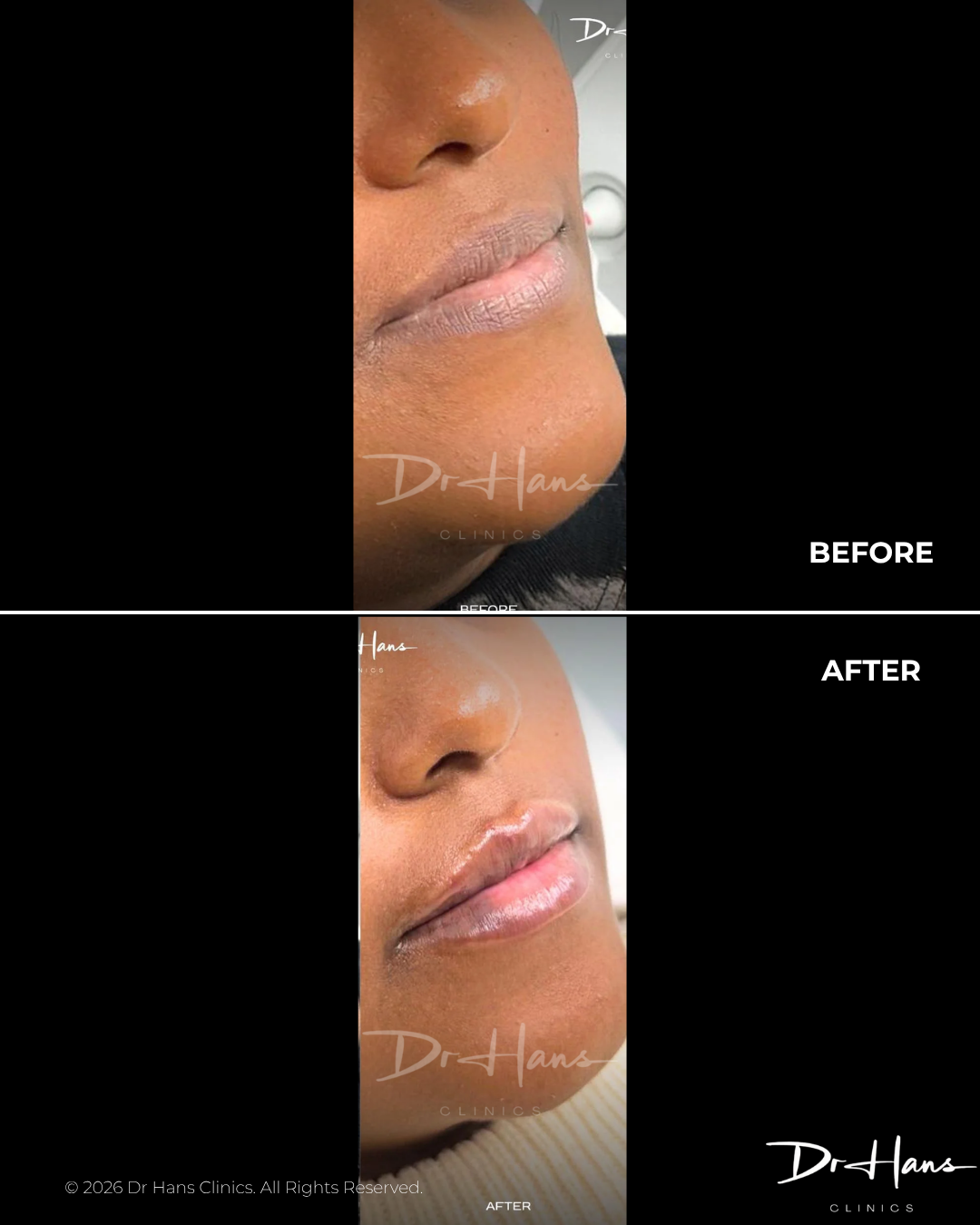 Close-up side-by-side of a person’s lower face showing before (left) and after (right) lip enhancement, highlighting fuller lips and smoother skin around the mouth as a cosmetic result.