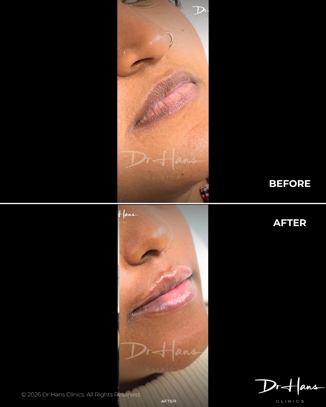 Comparison image showing lips before and after cosmetic lip augmentation: top panel with thinner lips, bottom panel with fuller, glossy lips (Dr Hans Clinics)