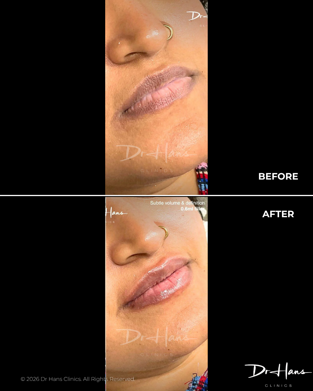 Close-up of a woman's lower face showing before-and-after lip filler results, with fuller, glossy lips after treatment.