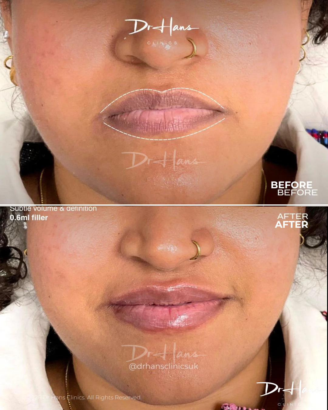 Two-panel photo showing lip filler treatment; top: before with thin lips, bottom: after with fuller, glossy lips after 0.6 ml filler.