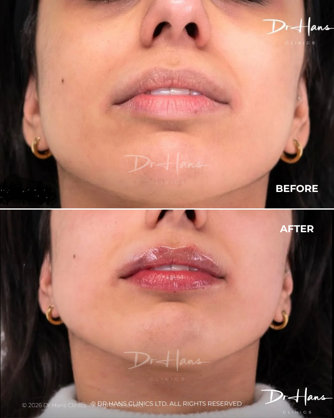 Two-panel close-up of the lower face showing lip enhancement: top 'Before' with natural lips, bottom 'After' with fuller, glossy lips (Dr. Hans Clinics).