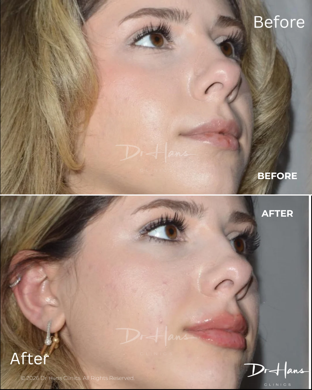 Before and after side-profile photos showing lip augmentation results in a woman's face.