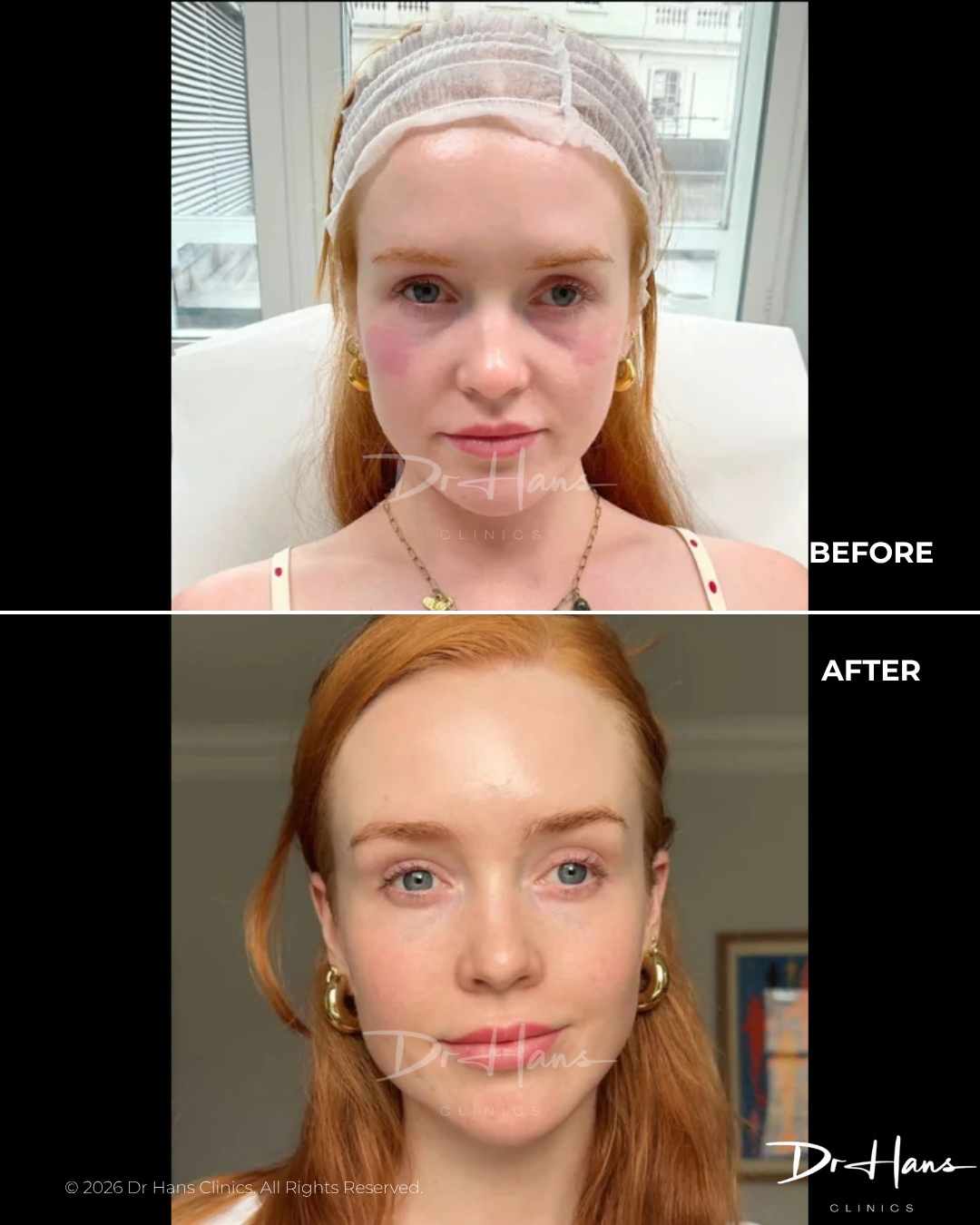 Before and after comparison of a young woman showing facial redness on the cheeks (rosacea) pre-treatment.
