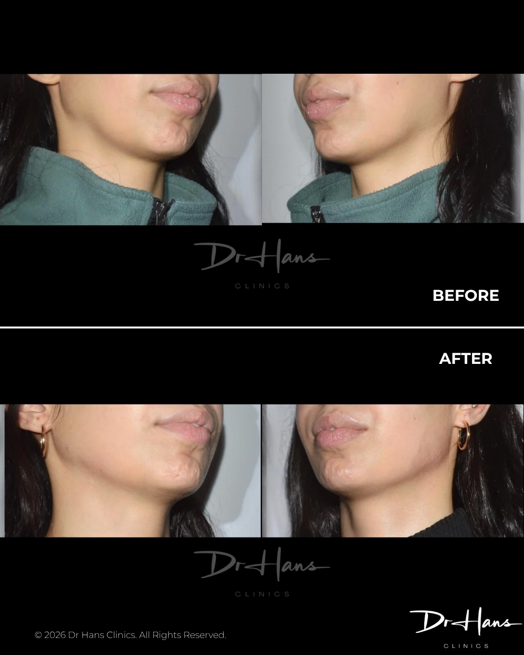 Before-and-after collage showing a woman's left-side jawline improvement after treatment at Dr Hans Clinics (front and side views).