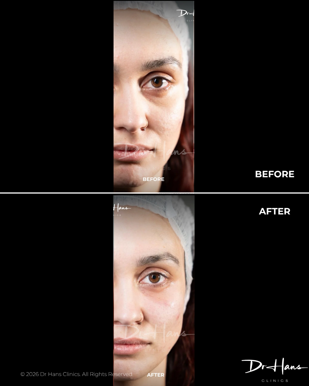 Side-by-side clinical portrait: top half shows the 'Before' close-up of a woman's face, bottom half shows the 'After' result with smoother, clearer skin (treatment at Dr Hans Clinics).