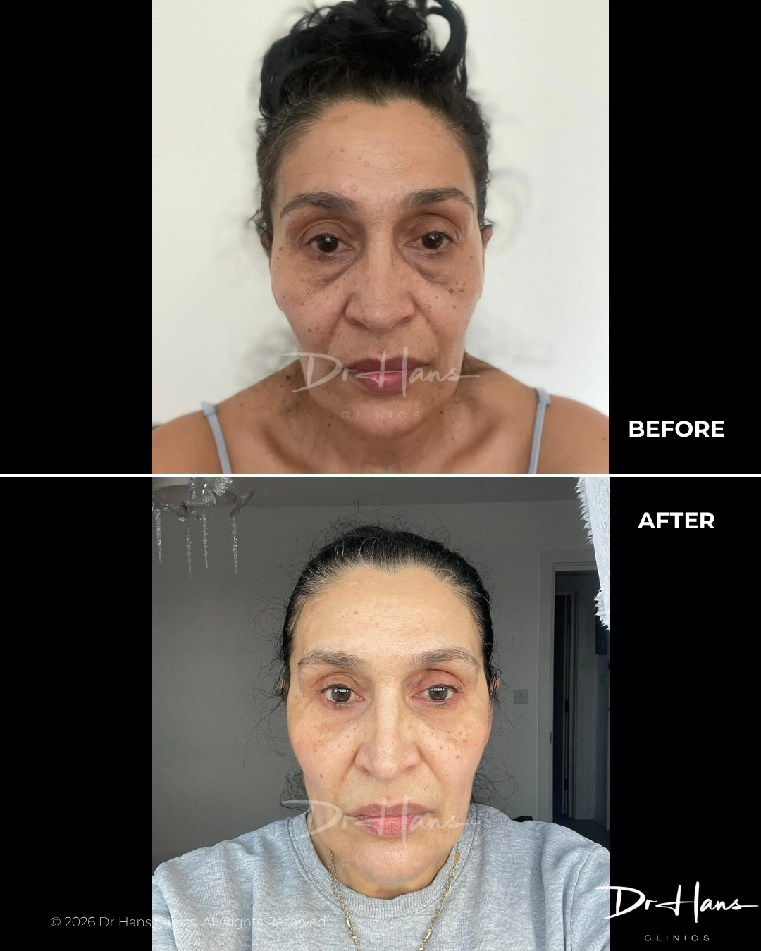 Before and after photo set showing facial rejuvenation results: top 'Before' image with sagging skin, bottom 'After' image with smoother complexion and brighter tone.