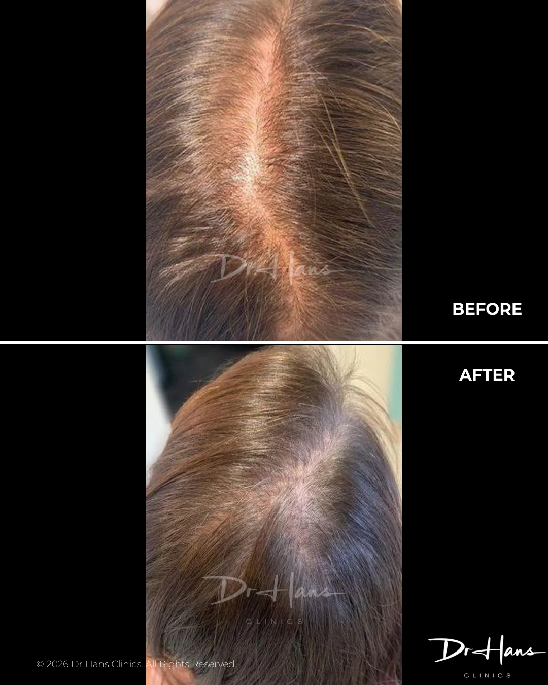 Before and after photos showing improved hair density along a central part on the scalp of a woman by Dr. Hans Clinics.