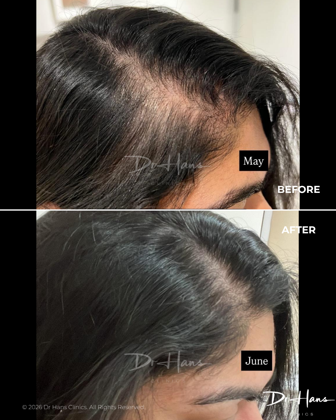 Side-by-side before-and-after showing thinning at the temple resolved after treatment; top image labeled 'May' (before) and bottom image labeled 'June' (after).