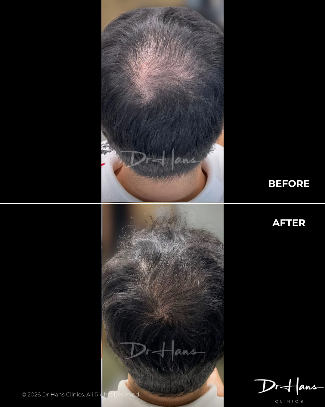 Before-and-after comparison of a man's crown: top shows thinning hair, bottom shows fuller coverage after treatment at Dr. Hans Clinics