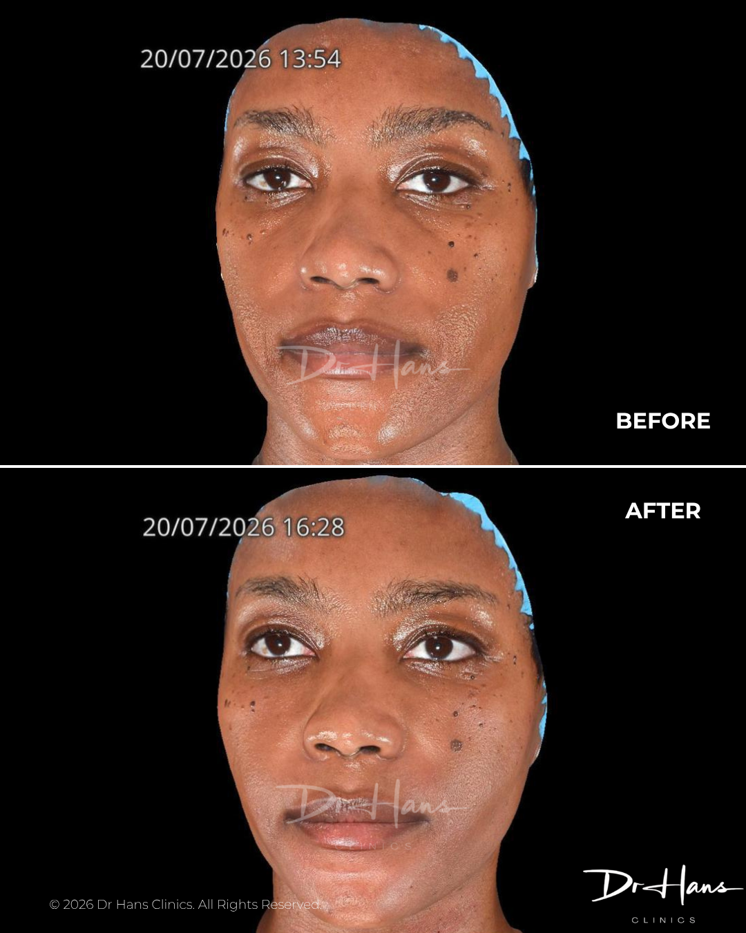 Before: close-up of a dark-skinned woman's face with dark spots and freckles, wearing a blue cap, against a black background. 20/07/2026 13:54 timestamp visible on image, labeled BEFORE.