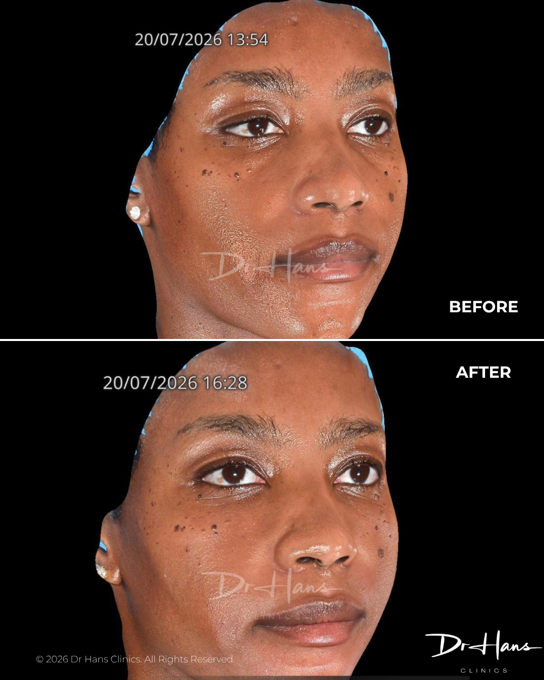 Before-and-after collage of a woman's face: left panel shows blemishes and shine; right panel shows smoother, clearer skin after treatment.