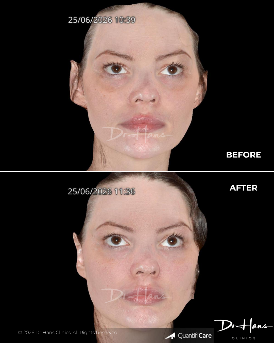 Before-and-after close-up of a woman's face showing facial rejuvenation; times 10:39 (Before) and 11:36 (After).