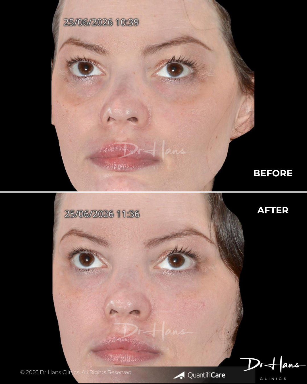 Two-panel comparison: before (top) and after (bottom) of a woman's face; after shows smoother skin, reduced redness under the eyes, and a more even complexion.