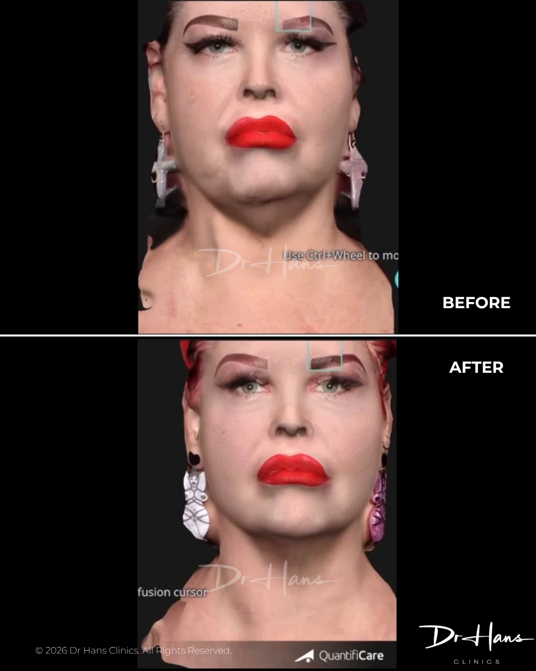 Before and after photos of a woman showing facial rejuvenation results (lifted jawline and fuller lips).