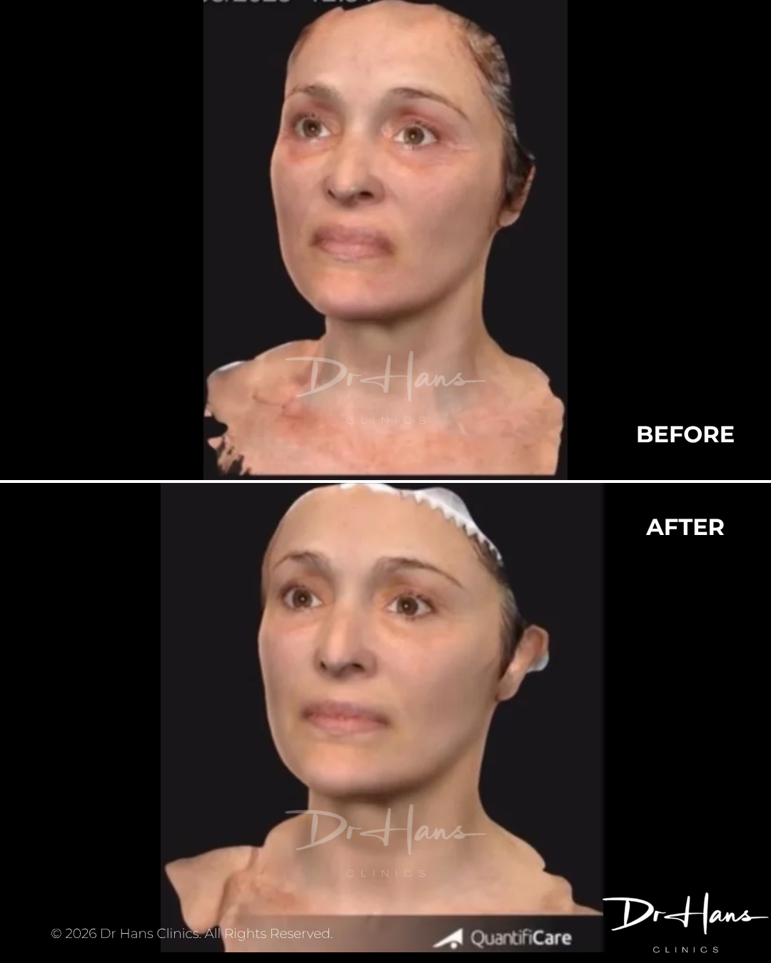 Before and after facial rejuvenation: improvements in neck and lower-face contour with smoother skin and lifted jawline after treatment (Dr Hans Clinics).