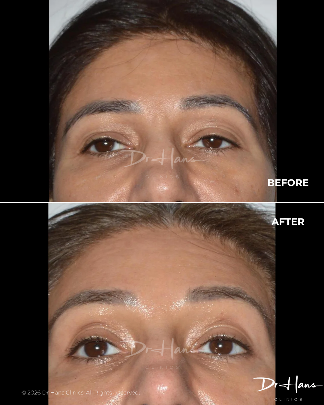 Before-and-after close-up of a woman's eyes showing eyelid/brow lift results, with reduced droop and brighter, more open lids.