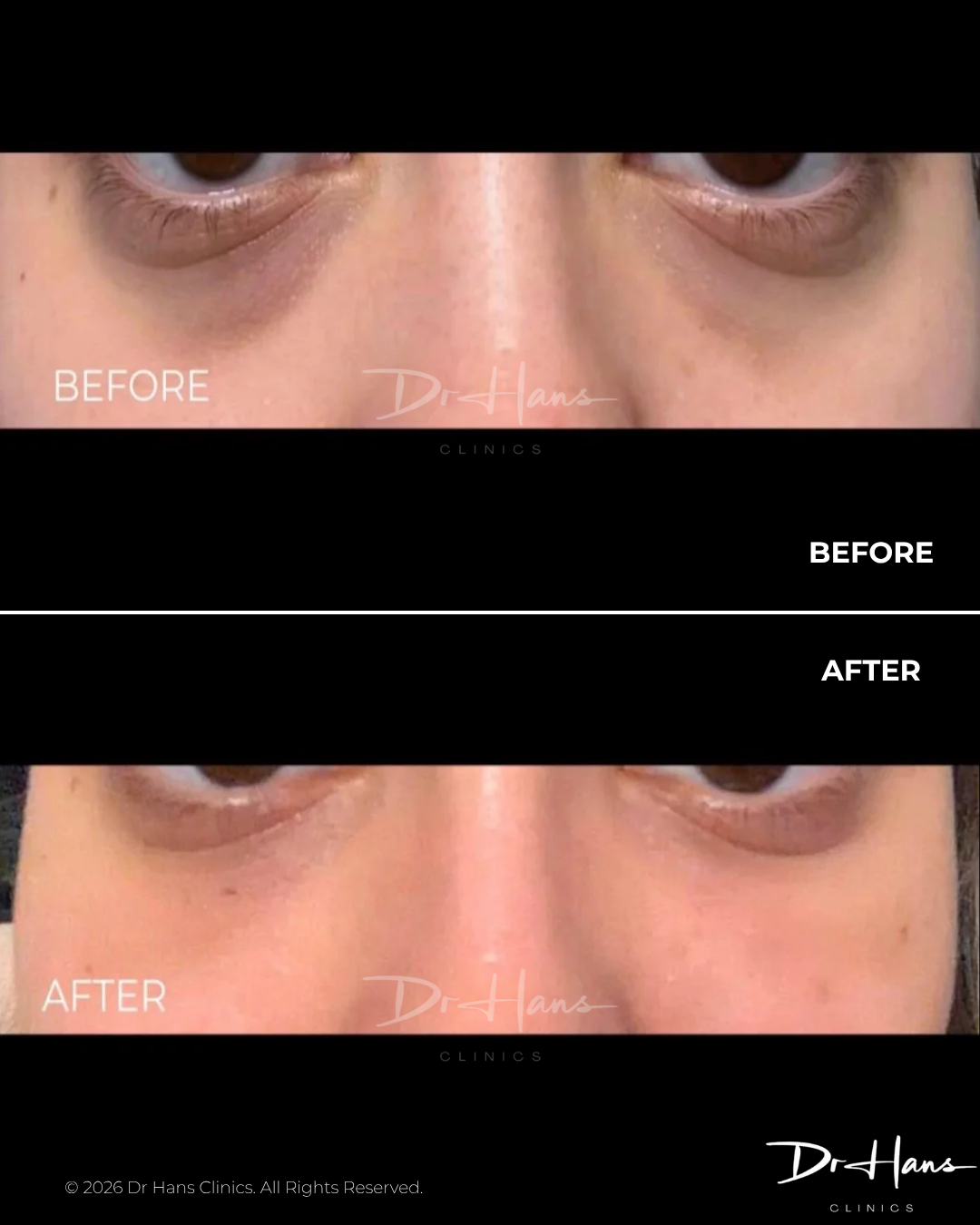 Close-up, side-by-side comparison of the under-eye area labeled BEFORE and AFTER, showing reduced darkness and smoother skin after treatment.