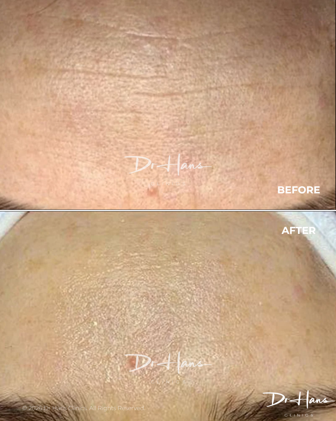 Before and after close-up of facial skin showing improved smoothness and reduced pore texture after treatment (forehead area).