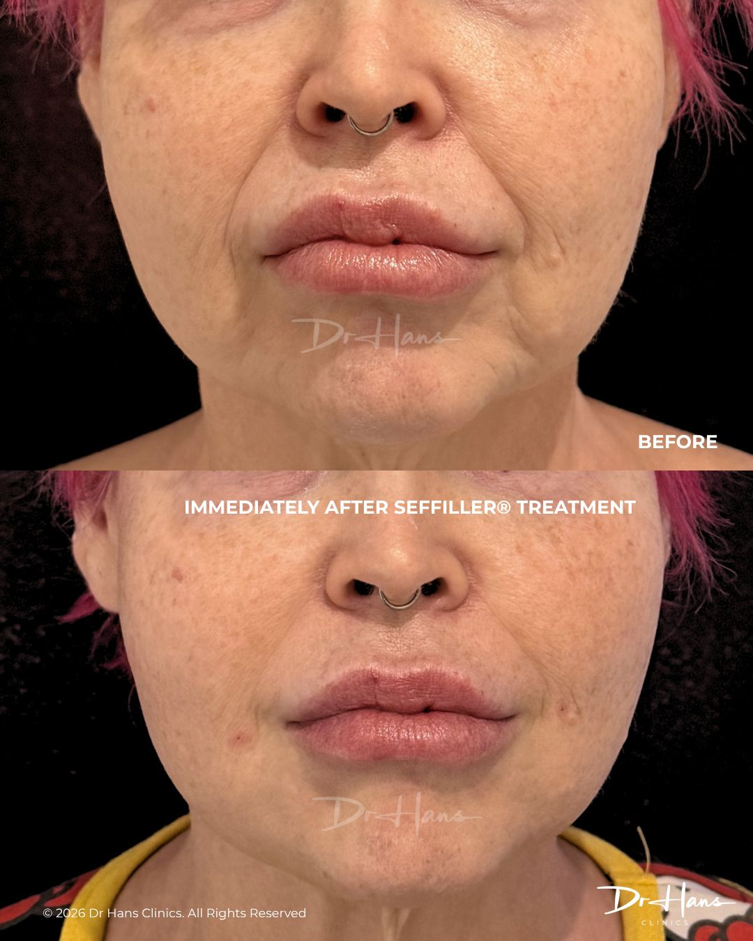 Split-screen comparison: before (top) with thinner lips and after (bottom) with fuller lips following Seffiller treatment.