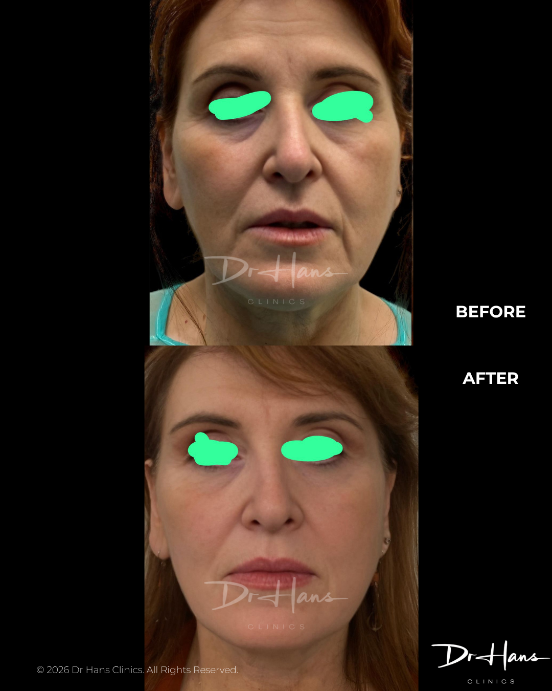 Before-and-after photos of a woman showing facial rejuvenation results; smoother cheeks and reduced under-eye bags after treatment.