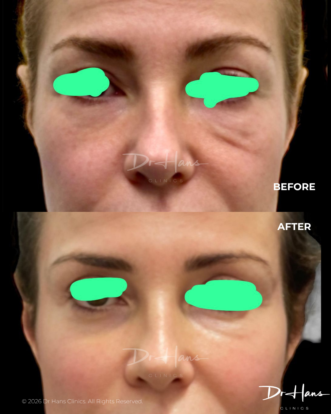 Before and after close-up of the eye area showing reduced under-eye bags after treatment, on a female patient.