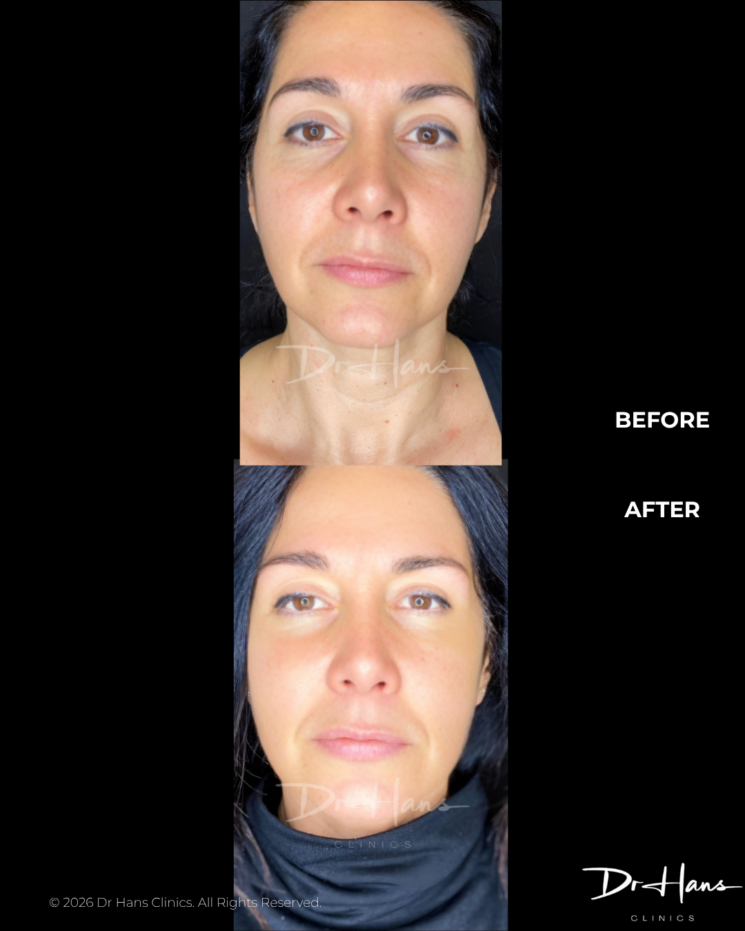 Before and after close-up: woman shows improved skin tone and jawline after treatment (top before, bottom after).