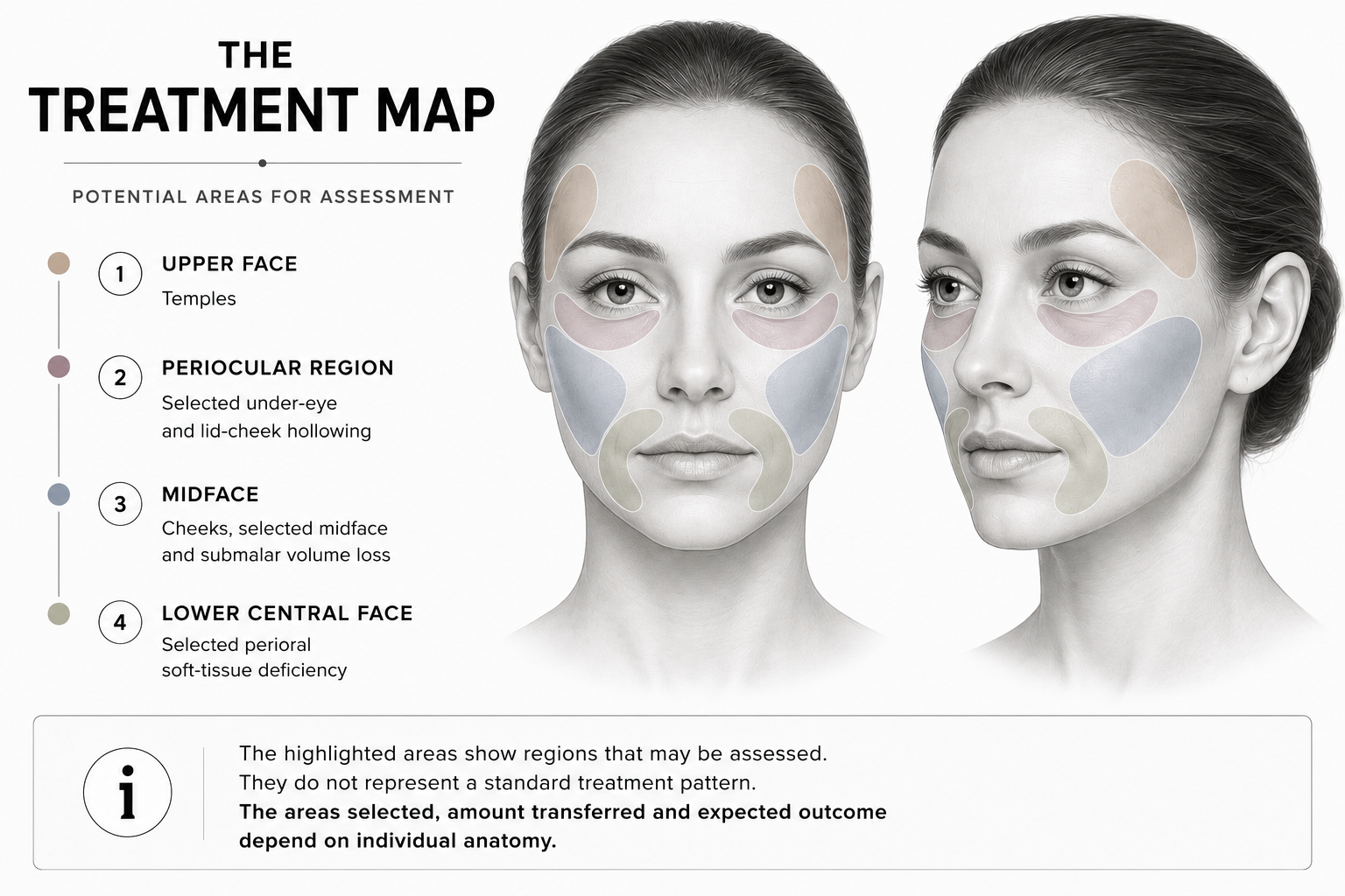 Infographic of a facial treatment map showing four numbered regions and colored zones on a front and side view of a woman's face, labeled upper face, periorbital region, midface, and lower central face.