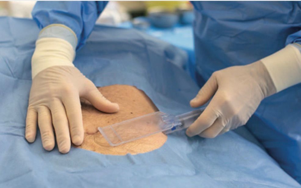 Close-up of gloved hands performing an abdominal procedure, with a clear plastic wound retractor exposed at an incision under blue sterile drapes.