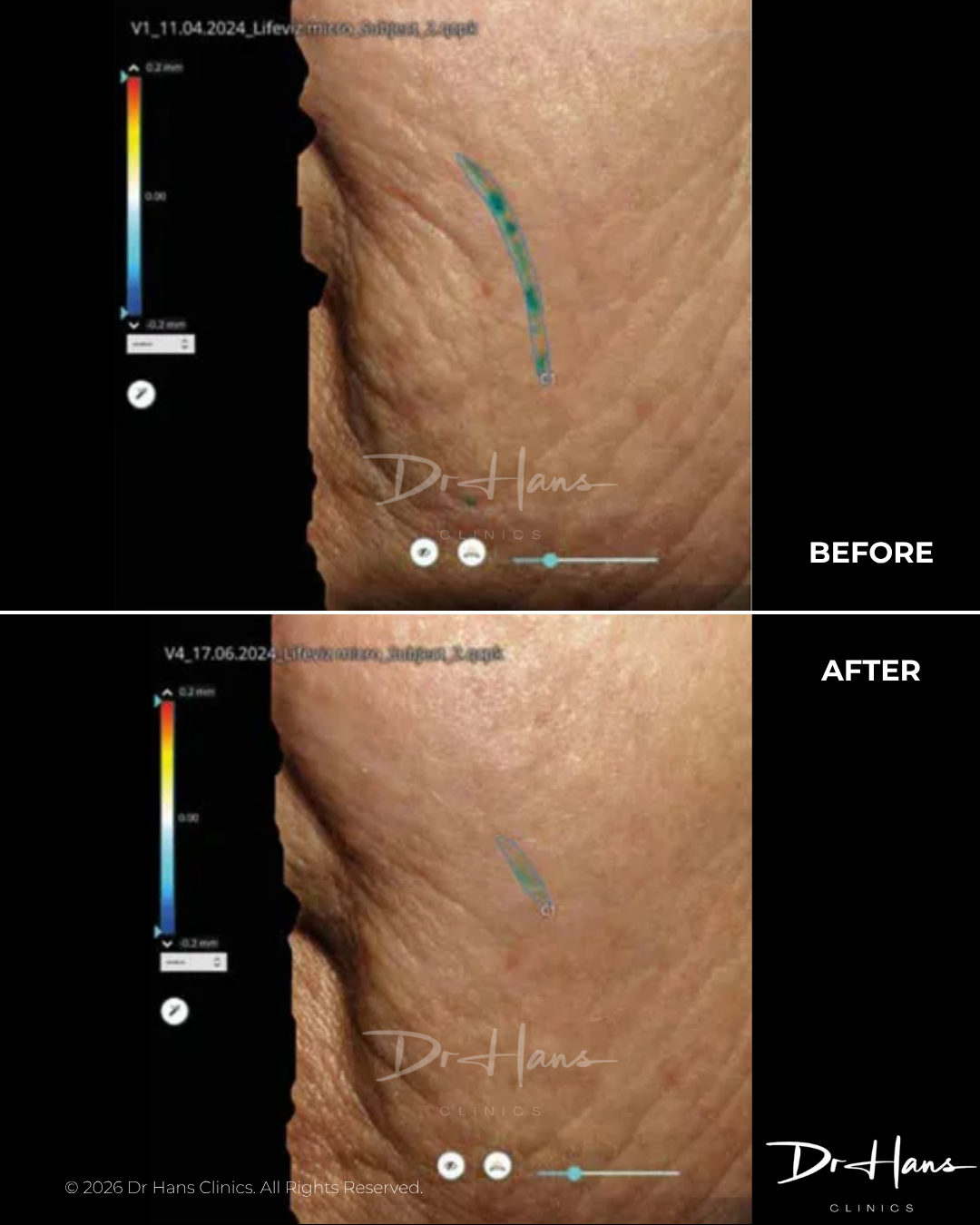 Before and after close-up of treated skin, showing a curved blue-green marker along the skin with a left vertical color-depth scale; BEFORE vs AFTER.