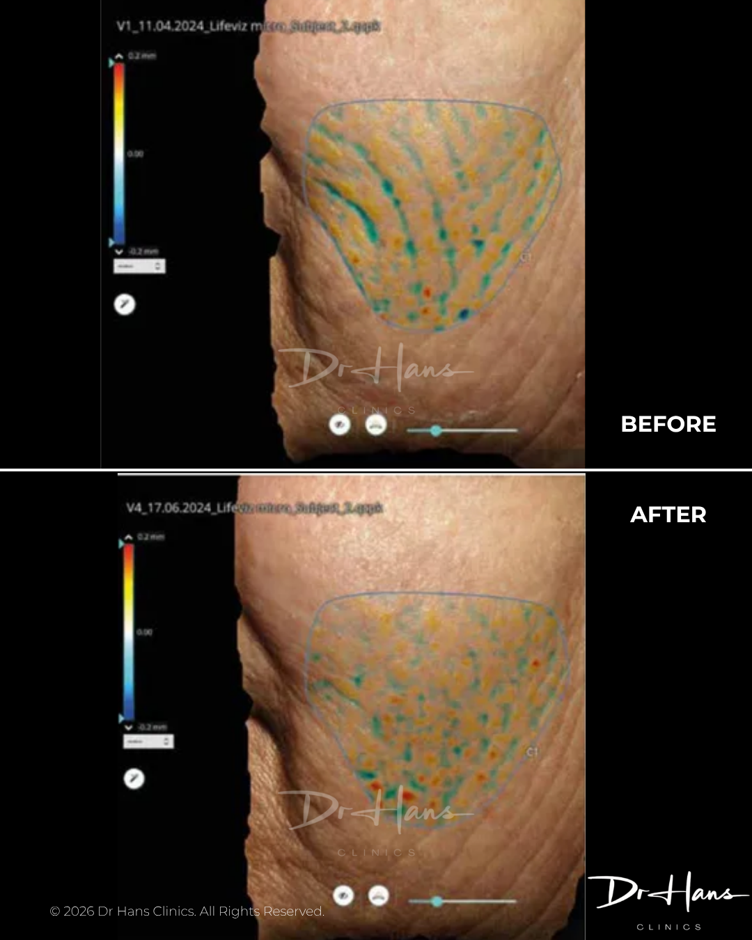 Before and after images showing a color-coded skin map on the upper arm, illustrating improved skin texture after treatment at Dr. Hans Clinics.
