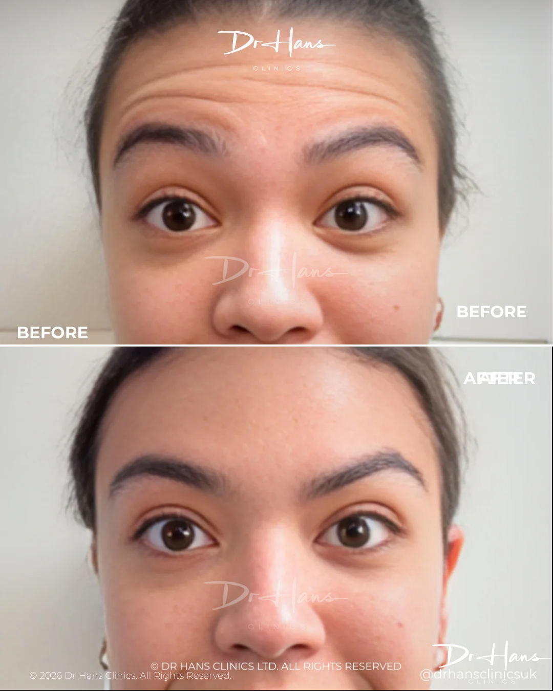 DrHans - Before After - Upper Face - Dr Hans Clinics Before-and-after of a woman's forehead: top shows deep horizontal wrinkles, bottom shows smoother skin after treatment.